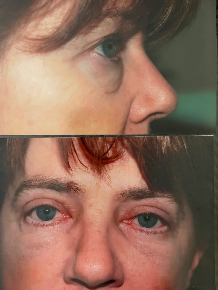 Facial plastics before and after